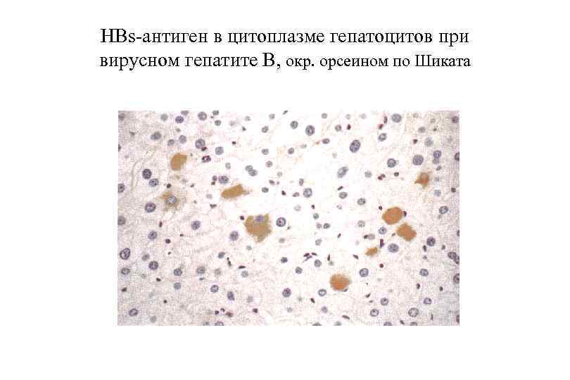 HBs-антиген в цитоплазме гепатоцитов при вирусном гепатите В, окр. орсеином по Шиката 