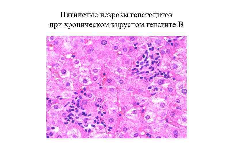 Пятнистые некрозы гепатоцитов при хроническом вирусном гепатите В 