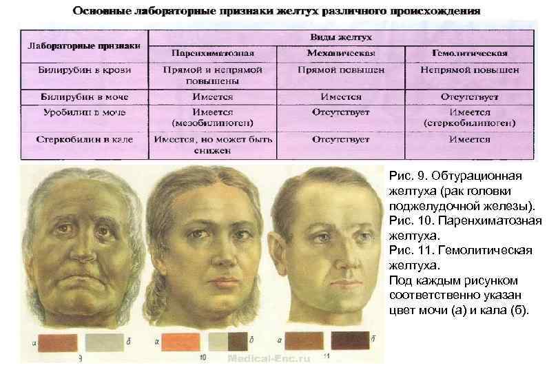 Рис. 9. Обтурационная желтуха (рак головки поджелудочной железы). Рис. 10. Паренхиматозная желтуха. Рис. 11.