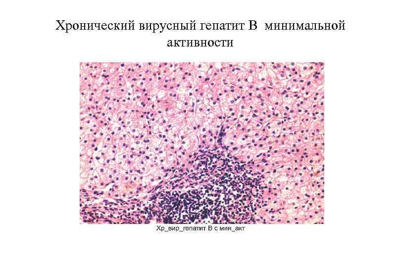 Хронический вирусный гепатит В минимальной активности 