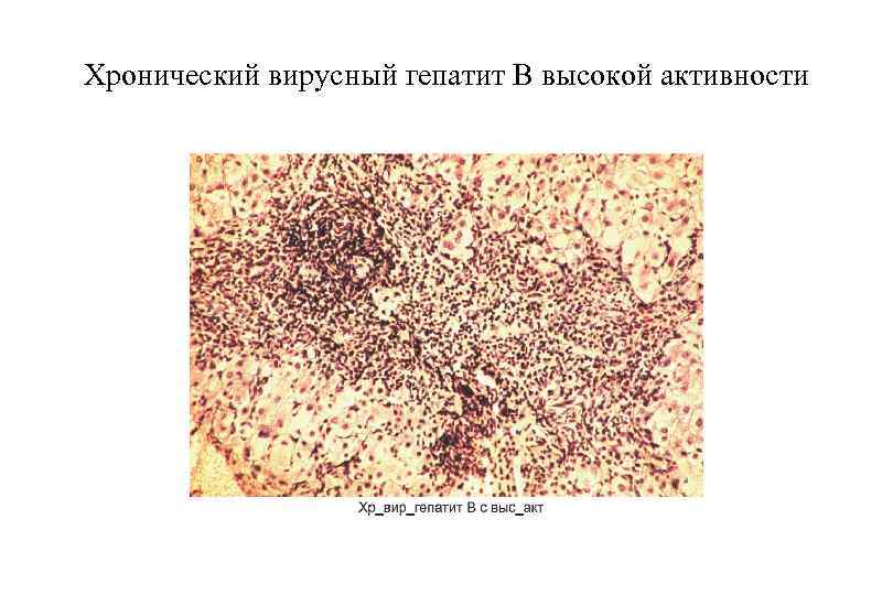 Хронический вирусный гепатит В высокой активности 