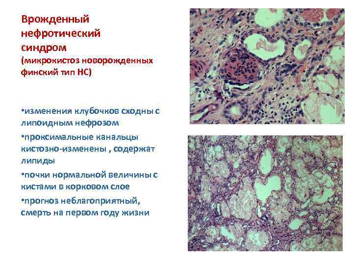 Врожденный нефротический синдром у детей презентация