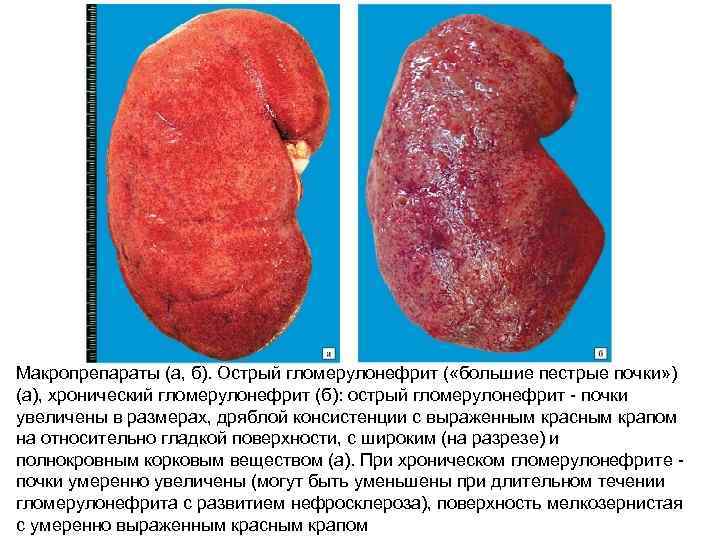 Острый гломерулонефрит картинки