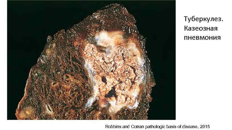 Туберкулез. Казеозная пневмония Robbins and Cotran pathologic basis of disease, 2015 