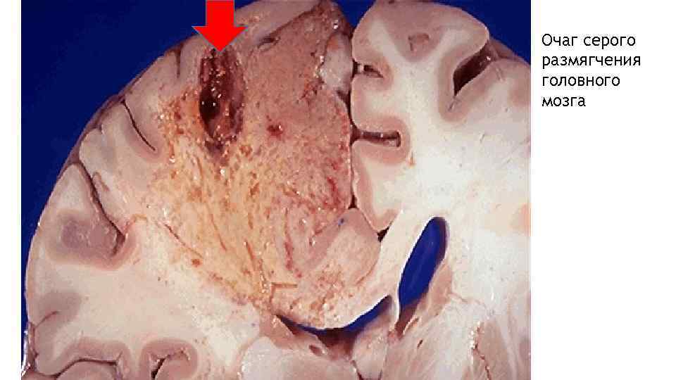 Очаг серого размягчения головного мозга 