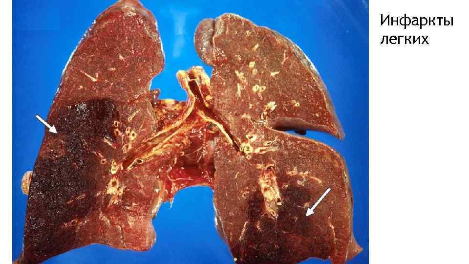 Инфаркты легких 