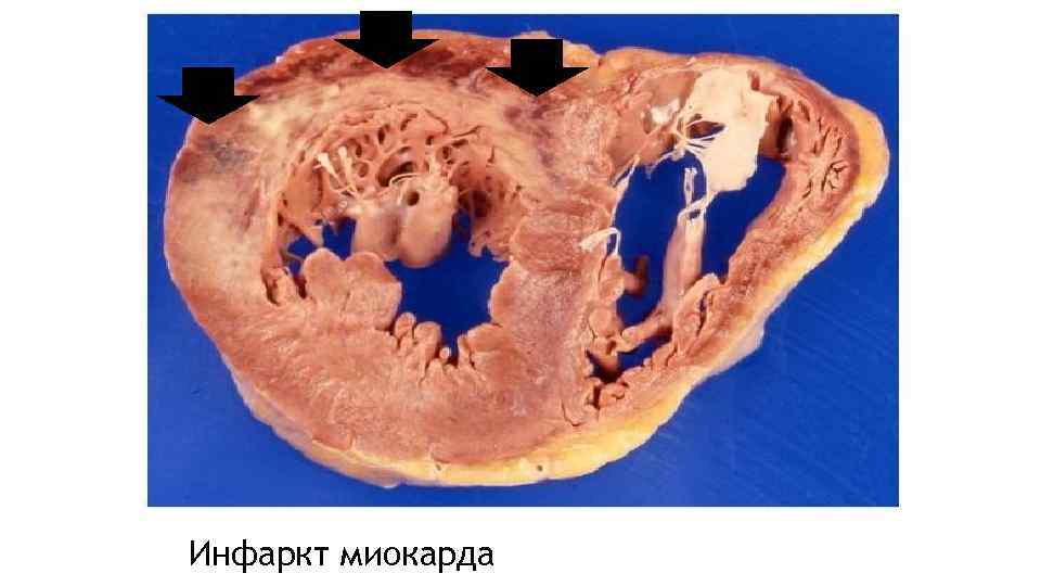 Инфаркт миокарда 