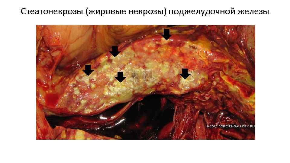 Стеатонекрозы (жировые некрозы) поджелудочной железы 
