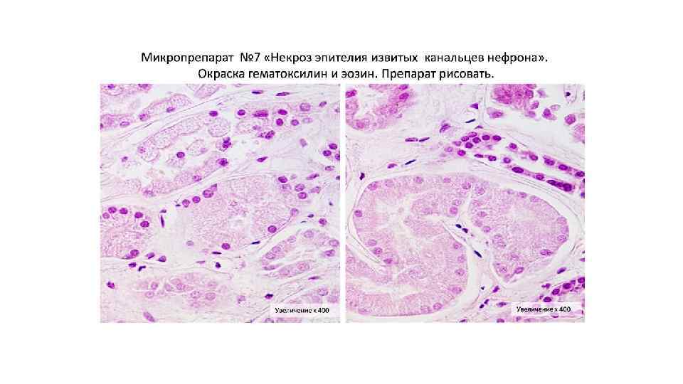 Коклюш патанатомия презентация