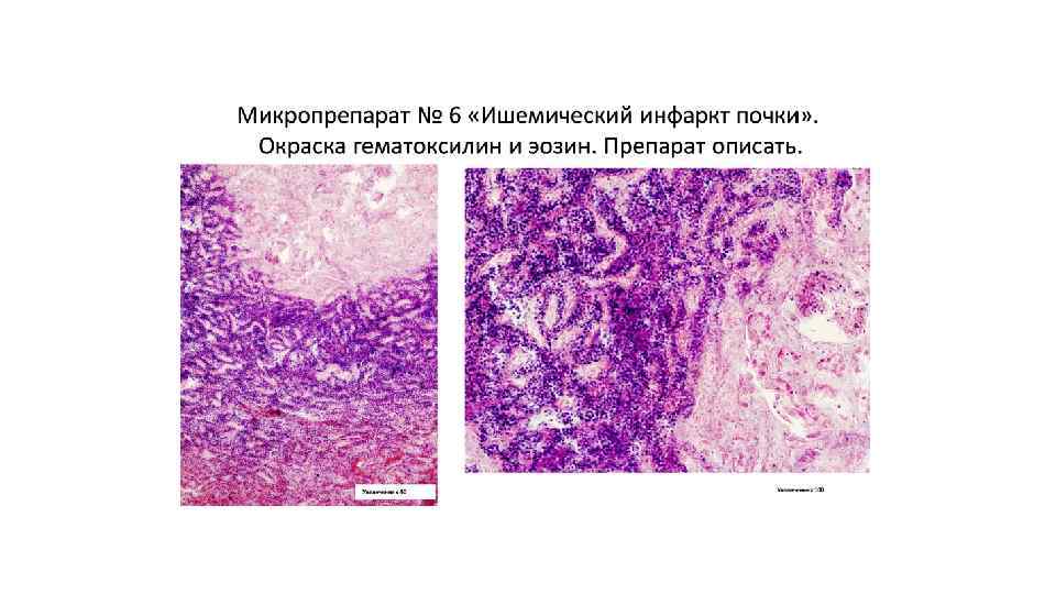 Патологическая анатомия это. Инфаркт почки с геморрагическим венчиком микропрепарат. Васкуляризация тромба патологическая анатомия. Ишемия патологическая анатомия. Демаркационная зона патанатомия.