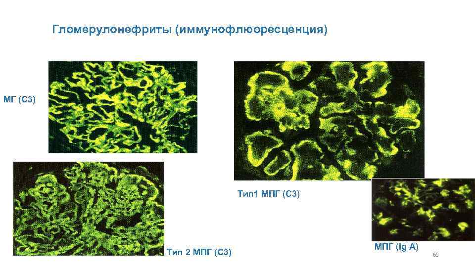 Гломерулонефриты (иммунофлюоресценция) МГ (С 3) Тип 1 МПГ (С 3) Тип 2 МПГ (С