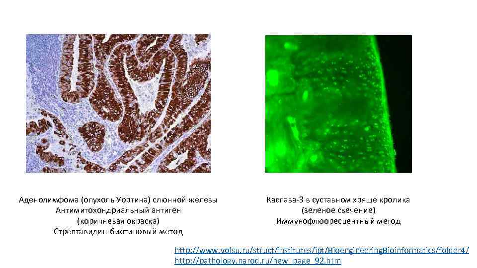 Аденолимфома (опухоль Уортина) слюнной железы Антимитохондриальный антиген (коричневая окраска) Стрептавидин-биотиновый метод Каспаза-3 в суставном