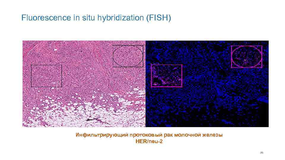 Fluorescence in situ hybridization (FISH) Инфильтрирующий протоковый рак молочной железы HER/neu-2 86 