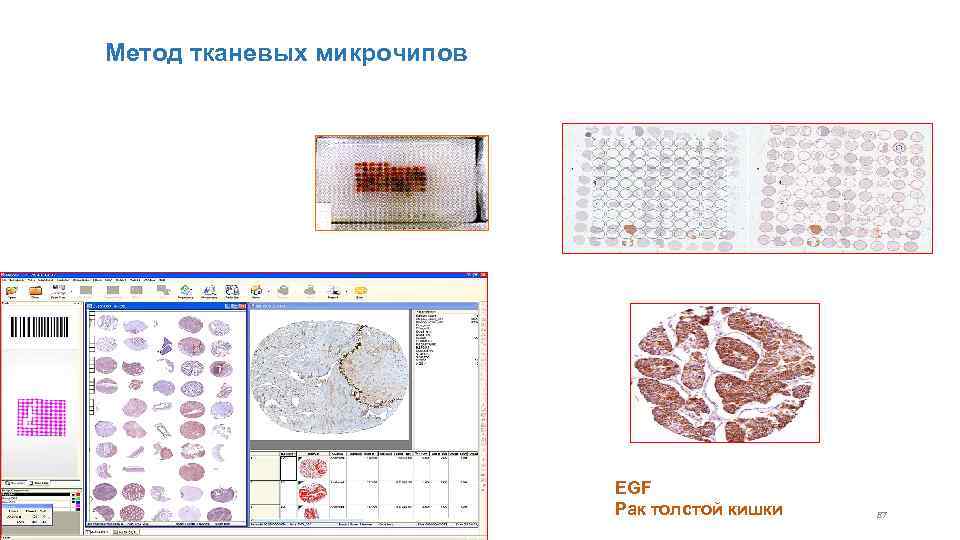 Метод тканевых микрочипов EGF Рак толстой кишки 87 