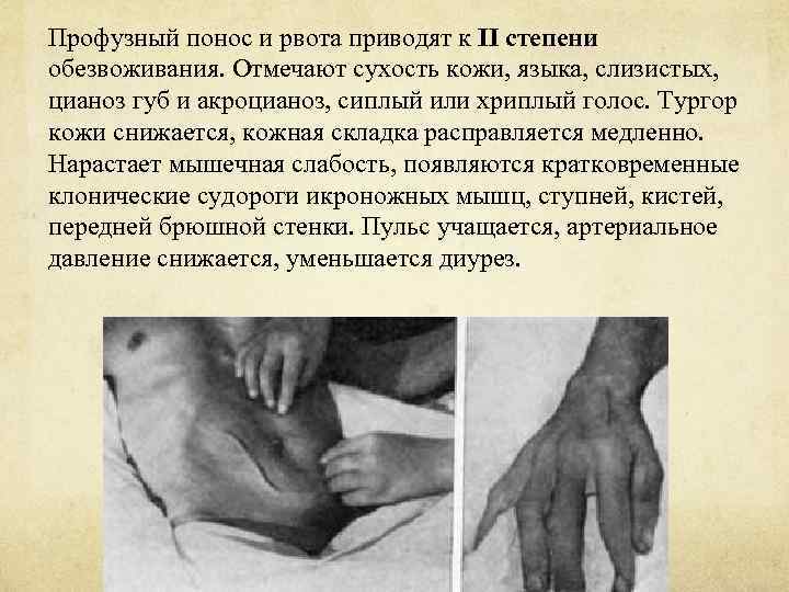 Профузный понос и рвота приводят к II степени обезвоживания. Отмечают сухость кожи, языка, слизистых,