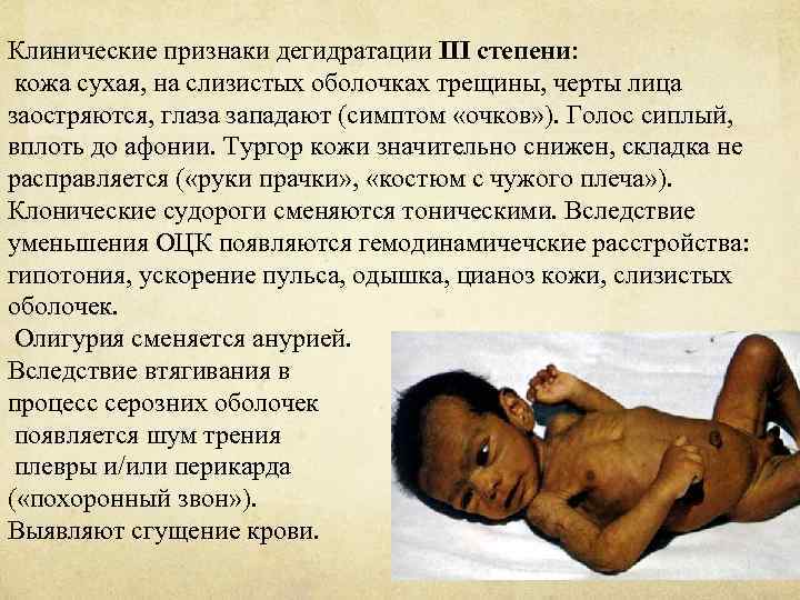 Клинические признаки дегидратации III степени: кожа сухая, на слизистых оболочках трещины, черты лица заостряются,