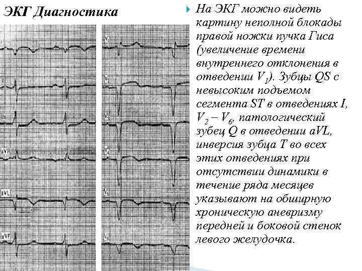 ЭКГ Диагностика На ЭКГ можно видеть картину неполной блокады правой ножки пучка Гиса (увеличение