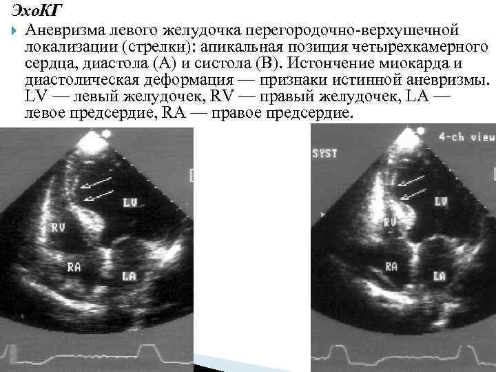 Картине истинной аневризмы в области верхушки миокарда левого желудочка соответствует