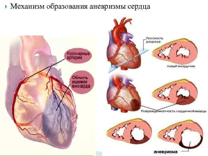 Аневризма сердца. Острая и хроническая аневризма левого желудочка. Острая аневризма сердца стенка. Левожелудочковая аневризма. Осложнения хронической аневризмы сердца.