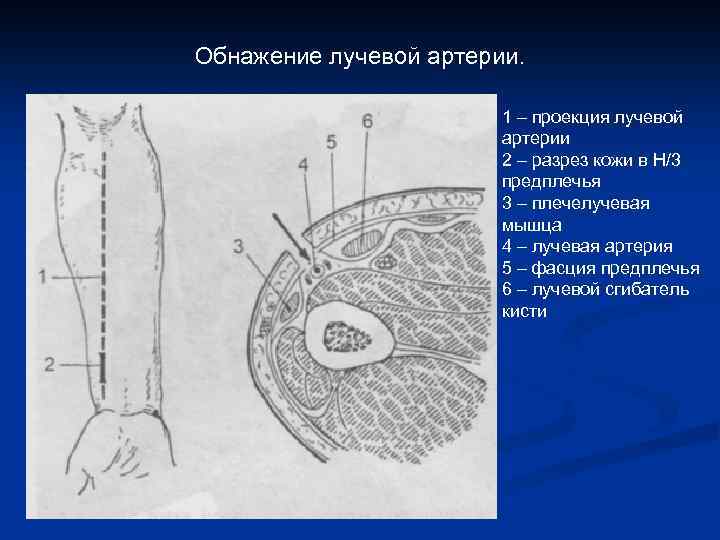 Обнажение лучевой артерии. 1 – проекция лучевой артерии 2 – разрез кожи в Н/3