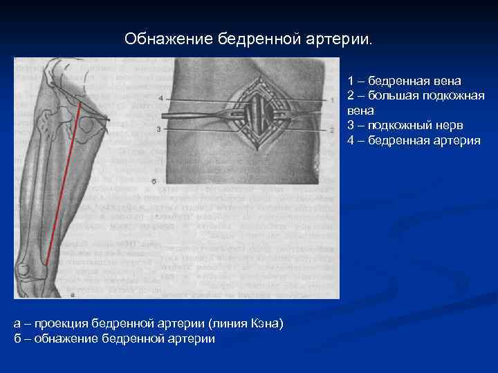 Обнажение бедренной артерии. 1 – бедренная вена 2 – большая подкожная вена 3 –