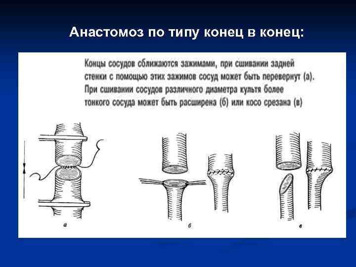 Анастомоз по типу конец в конец: 
