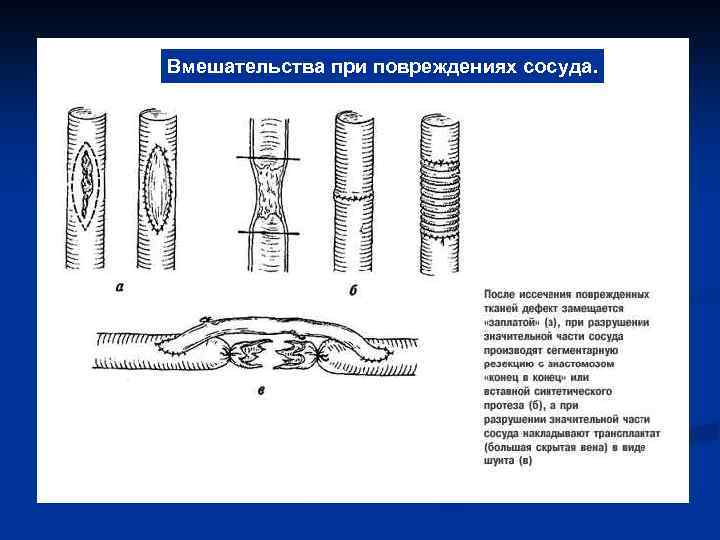 Вмешательства при повреждениях сосуда. 