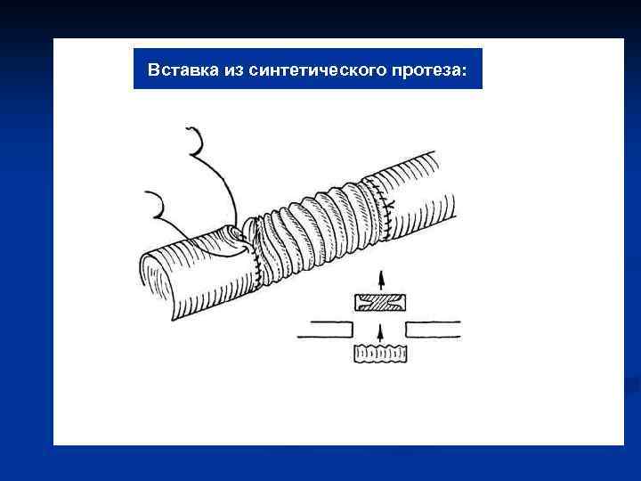 Вставка из синтетического протеза: 