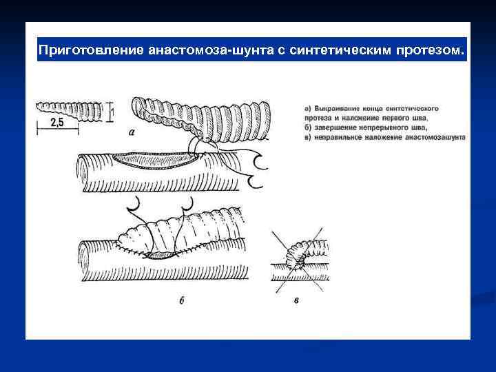 Приготовление анастомоза-шунта с синтетическим протезом. 