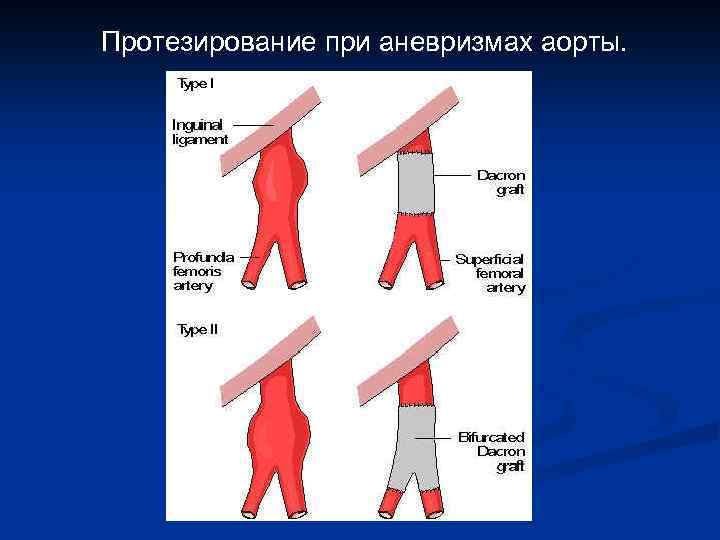 Протезирование при аневризмах аорты. 