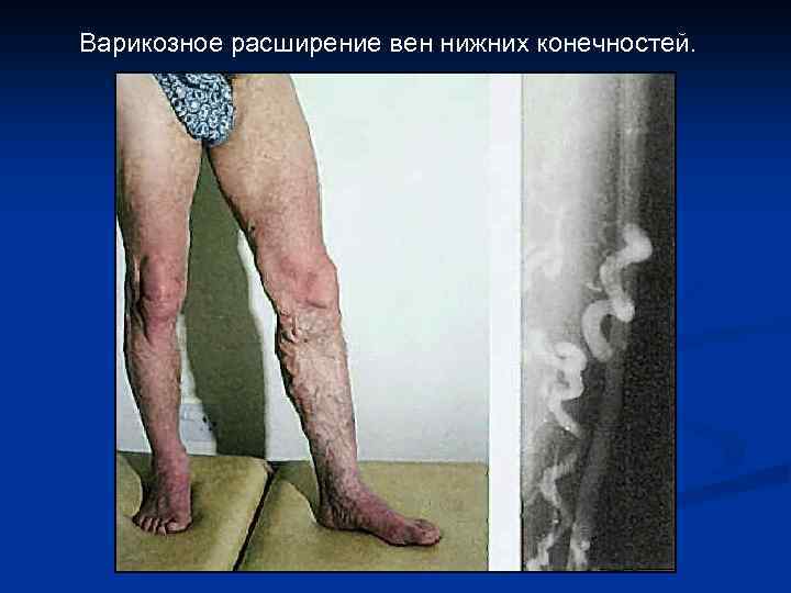 Варикозное расширение вен нижних конечностей. 