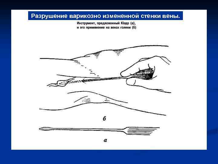 Разрушение варикозно измененной стенки вены. 