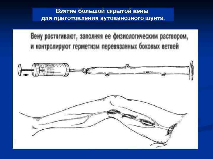 Взятие большой скрытой вены для приготовления аутовенозного шунта. 