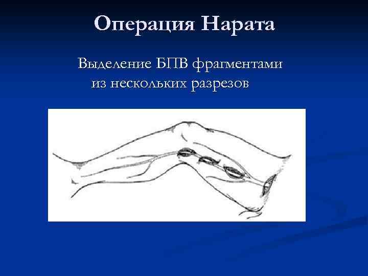 Операция Нарата Выделение БПВ фрагментами из нескольких разрезов 
