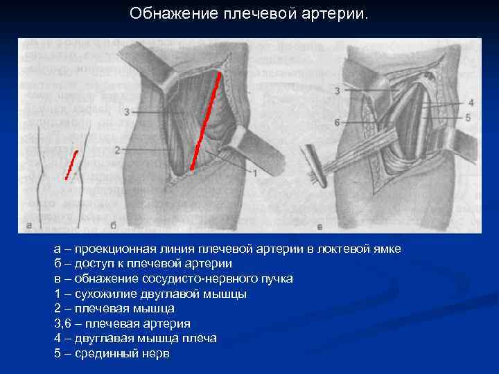 Обнажение плечевой артерии. а – проекционная линия плечевой артерии в локтевой ямке б –