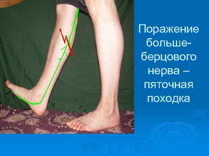 Поражение большеберцового нерва – пяточная походка 