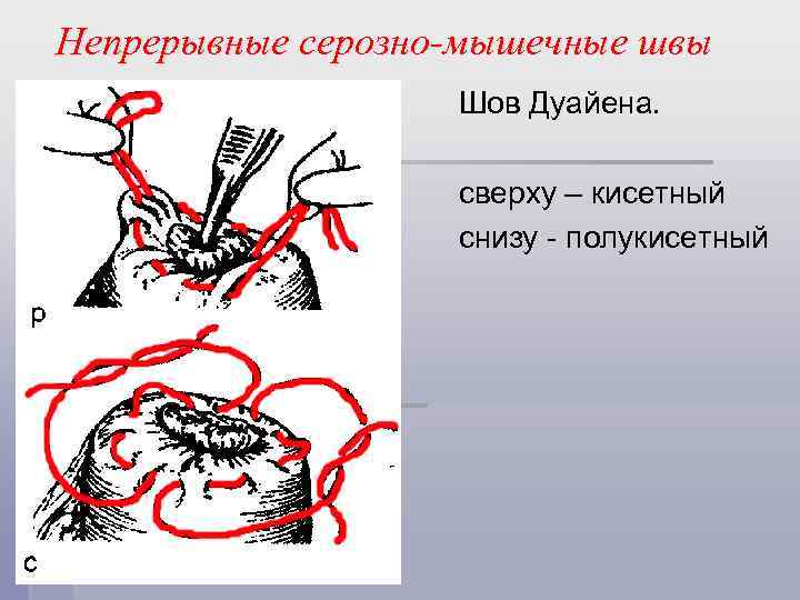 Непрерывные серозно-мышечные швы Шов Дуайена. сверху – кисетный снизу - полукисетный 