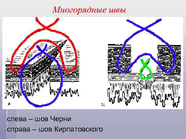 Многорядные швы слева – шов Черни справа – шов Кирпатовского 