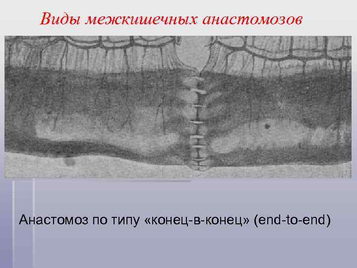 Виды межкишечных анастомозов Анастомоз по типу «конец-в-конец» (end-to-end) 