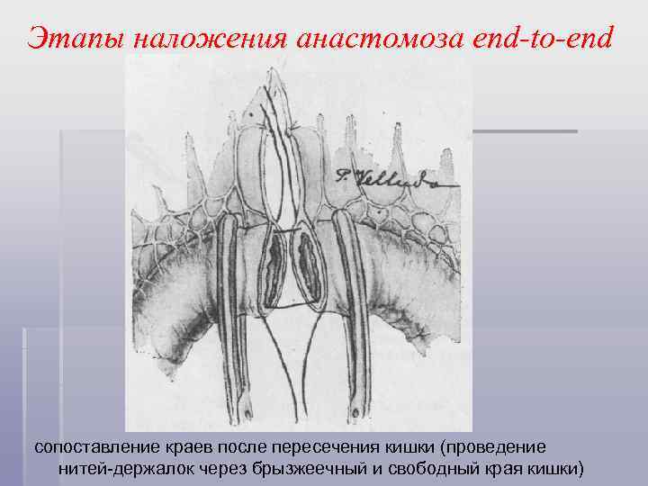 Этапы наложения анастомоза end-to-end сопоставление краев после пересечения кишки (проведение нитей-держалок через брызжеечный и
