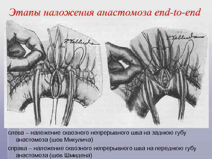 Этапы наложения анастомоза end-to-end слева – наложение сквозного непрерывного шва на заднюю губу анастомоза