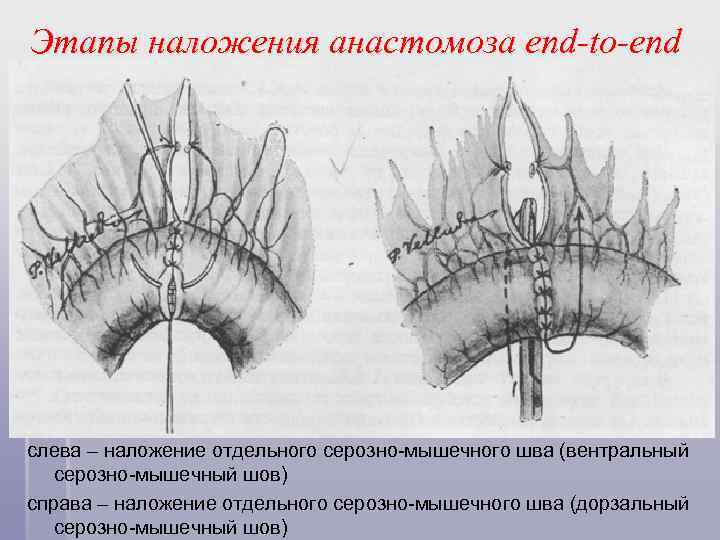 Этапы наложения анастомоза end-to-end слева – наложение отдельного серозно-мышечного шва (вентральный серозно-мышечный шов) справа