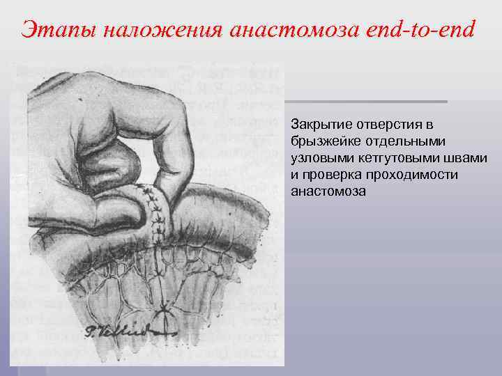Этапы наложения анастомоза end-to-end Закрытие отверстия в брызжейке отдельными узловыми кетгутовыми швами и проверка