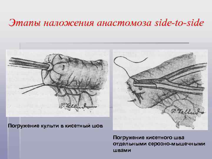 Этапы наложения анастомоза side-to-side Погружение культи в кисетный шов Погружение кисетного шва отдельными серозно-мышечными