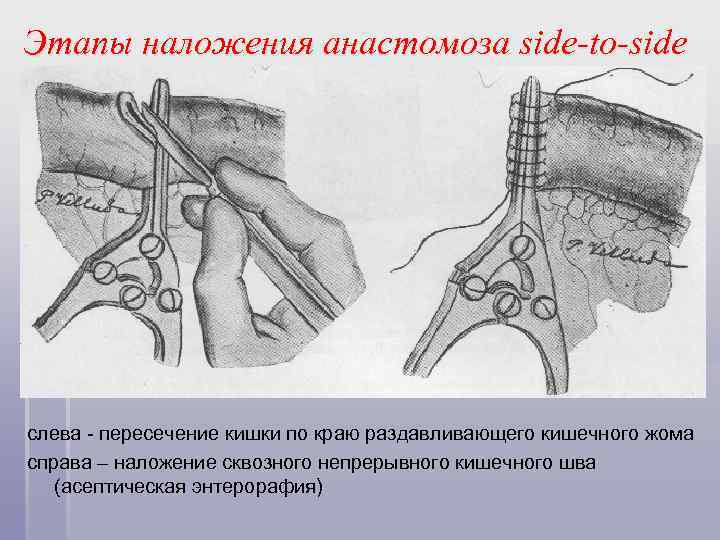 Этапы наложения анастомоза side-to-side слева - пересечение кишки по краю раздавливающего кишечного жома справа