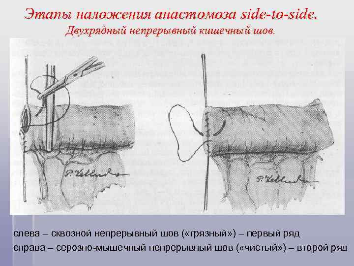 Этапы наложения анастомоза side-to-side. Двухрядный непрерывный кишечный шов. слева – сквозной непрерывный шов (