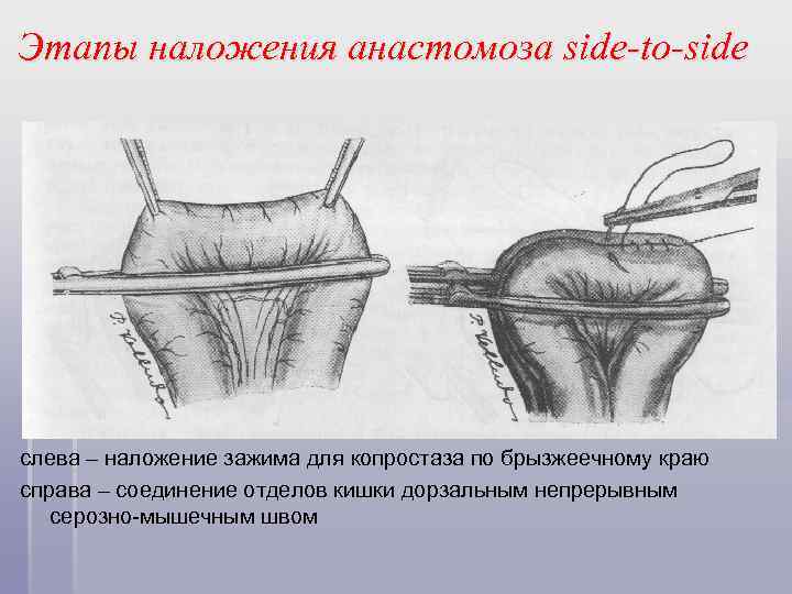Этапы наложения анастомоза side-to-side слева – наложение зажима для копростаза по брызжеечному краю справа