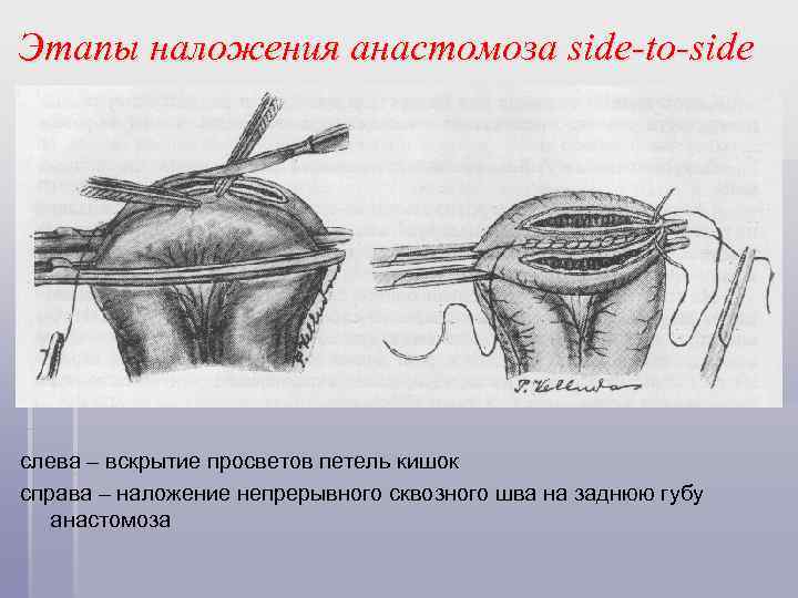 Этапы наложения анастомоза side-to-side слева – вскрытие просветов петель кишок справа – наложение непрерывного