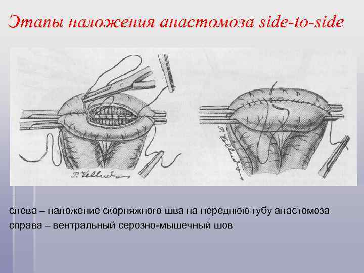 Этапы наложения анастомоза side-to-side слева – наложение скорняжного шва на переднюю губу анастомоза справа
