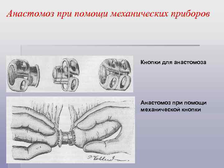 Анастомоз при помощи механических приборов Кнопки для анастомоза Анастомоз при помощи механической кнопки 